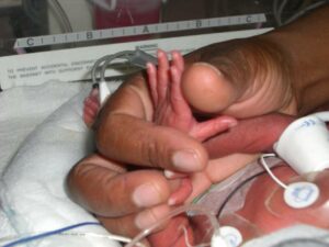 Neonatal hand wrapped around adult thumb in hospital incubator